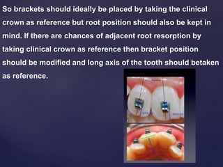 So brackets should ideally be placed by taking the clinical
crown as reference but root position should also be kept in
mind. If there are chances of adjacent root resorption by
taking clinical crown as reference then bracket position
should be modified and long axis of the tooth should betaken
as reference.
 