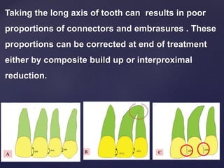 Taking the long axis of tooth can results in poor
proportions of connectors and embrasures . These
proportions can be corrected at end of treatment
either by composite build up or interproximal
reduction.
 