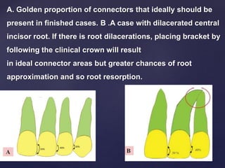 A. Golden proportion of connectors that ideally should be
present in finished cases. B .A case with dilacerated central
incisor root. If there is root dilacerations, placing bracket by
following the clinical crown will result
in ideal connector areas but greater chances of root
approximation and so root resorption.
 