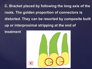 C. Bracket placed by following the long axis of the
roots. The golden proportion of connectors is
distorted. They can be resorted by composite built
up or interproximal stripping at the end of
treatment
 