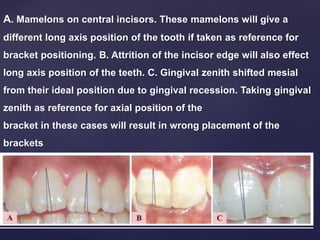 A. Mamelons on central incisors. These mamelons will give a
different long axis position of the tooth if taken as reference for
bracket positioning. B. Attrition of the incisor edge will also effect
long axis position of the teeth. C. Gingival zenith shifted mesial
from their ideal position due to gingival recession. Taking gingival
zenith as reference for axial position of the
bracket in these cases will result in wrong placement of the
brackets
 
