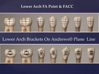 Lower Arch FA Point & FACC
Lower Arch Brackets On Andrews® Plane Line
 