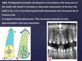 A&B. Preadjusted brackets not placed in accordance with long axis of
the tooth will result in increase or decrease expression of tip than the
built in tip. C.A x ray showing that both decreased and increased tip of
incisors due
to angular bracket placement. This increases chances of root
approximation and root resorption.
 