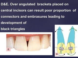 D&E. Over angulated brackets placed on
central incisors can result poor proportion of
connectors and embrasures leading to
development of
black triangles
 