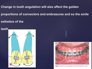 Change in tooth angulation will also affect the golden
proportions of connectors and embrasures and so the smile
esthetics of the
teeth.
 