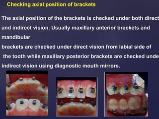 Checking axial position of brackets
The axial position of the brackets is checked under both direct
and indirect vision. Usually maxillary anterior brackets and
mandibular
brackets are checked under direct vision from labial side of
the tooth while maxillary posterior brackets are checked under
indirect vision using diagnostic mouth mirrors.
 