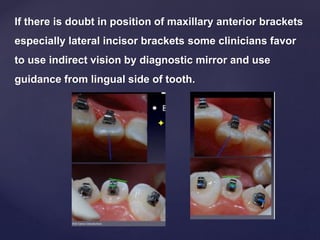 If there is doubt in position of maxillary anterior brackets
especially lateral incisor brackets some clinicians favor
to use indirect vision by diagnostic mirror and use
guidance from lingual side of tooth.
 