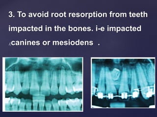 3. To avoid root resorption from teeth
impacted in the bones. i-e impacted
canines or mesiodens ..)
 
