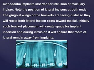 Orthodontic implants inserted for intrusion of maxillary
incisor. Note the position of lateral incisors at both ends.
The gingival wings of the brackets are facing distal so they
will rotate both lateral incisor roots toward mesial. Initially
such bracket placement will create space for implant
insertion and during intrusion it will ensure that roots of
lateral remain away from implants.
 