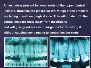 A mesiodens present between roots of the upper central
incisors. Brackets are placed so that wings of the brackets
are facing mesial on gingival side. This will rotate both the
central incisors roots away from mesiodens
and will give good access to surgeons for removing it
without causing any damage to central incisor roots.
 