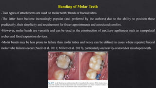 Banding of Molar Teeth
-Two types of attachments are used on molar teeth: bands or buccal tubes.
-The latter have become increasingly popular (and preferred by the authors) due to the ability to position these
predictably, their simplicity and requirement for fewer appointments and associated comfort.
-However, molar bands are versatile and can be used in the construction of auxiliary appliances such as transpalatal
arches and fixed expansion devices.
-Molar bands may be less prone to failure than molar tubes and hence can be utilized in cases where repeated buccal
molar tube failures occur (Nazir et al. 2011; Millett et al. 2017), particularly on heavily-restored or misshapen teeth.
 