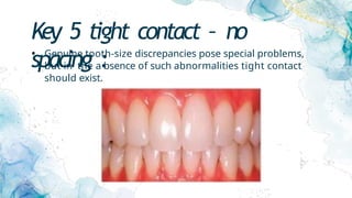 Key 5 tight contact – no
spacing :
• Genuine tooth-size discrepancies pose special problems,
but in the a bsence of such abnormalities tight contact
should exist.
 