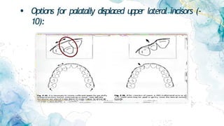 • Options for palatally displaced upper lateral incisors (-
10):
 