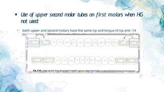 • Use of upper second molar tubes on first molars when HG
not used:
• both upper and second molars have the same tip and torque (0 tip and -14
torque) so could be used on the same side.
 