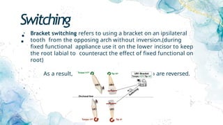 Switching
:
• Bracket switching refers to using a bracket on an ipsilateral
tooth from the opposing arch without inversion.(during
fixed functional appliance use it on the lower incisor to keep
the root labial to counteract the effect of fixed functional on
root)
As a result, the built-in torque and the tip are reversed.
•
 