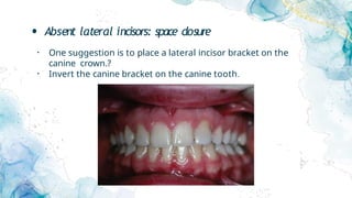 • Absent lateral incisors: space closure
• One suggestion is to place a lateral incisor bracket on the
canine crown.?
• Invert the canine bracket on the canine tooth.
 