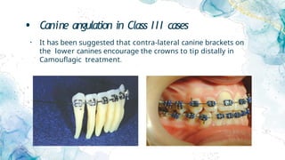 • Canine angulation in Class III cases
• It has been suggested that contra-lateral canine brackets on
the lower canines encourage the crowns to tip distally in
Camouflagic treatment.
 