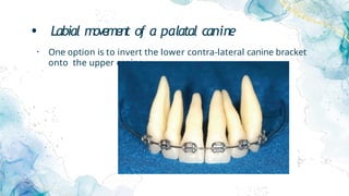 • Labial movement of a palatal canine
• One option is to invert the lower contra-lateral canine bracket
onto the upper canine.
 