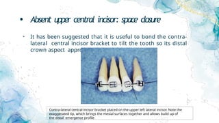 • Absent upper central incisor: space closure
• It has been suggested that it is useful to bond the contra-
lateral central incisor bracket to tilt the tooth so its distal
crown aspect approaches vertical.
Contra-lateral central incisor bracket placed on the upper left lateral incisor. Note the
exaggerated tip, which brings the mesial surfaces together and allows build up of
the distal emergence profile
 