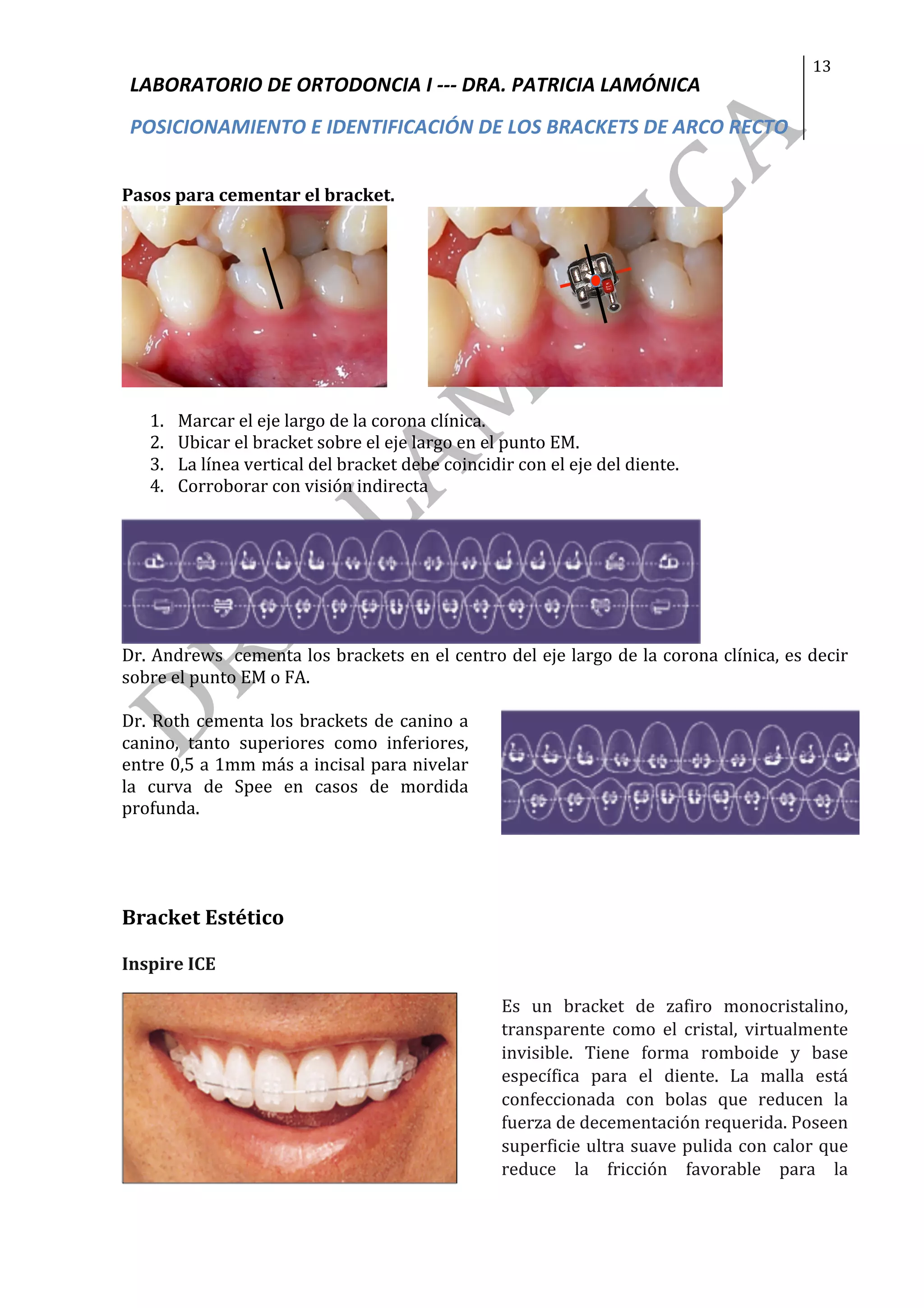 Posicionamiento e identificación de Brackets arco recto | PDF