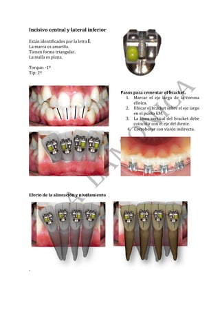 Incisivo	central	y	lateral	inferior	
	
Están	identificados	por	la	letra	I.	
La	marca	es	amarilla.	
Tienen	forma	triangular.	
La	malla	es	plana.	
	
Torque:	-1º	
Tip:	2º	
	
	
	
	
	
	
Pasos	para	cementar	el	bracket.	
1. Marcar	 el	 eje	 largo	 de	 la	 corona	
clínica.	
2. Ubicar	el	bracket	sobre	el	eje	largo	
en	el	punto	EM.	
3. La	línea	vertical	del	bracket	debe	
coincidir	con	el	eje	del	diente.	
	
	
	
	
4. Corroborar	con	visión	indirecta.	
	
Efecto	de	la	alineación	y	nivelamiento	
. 	
	
	 	
 