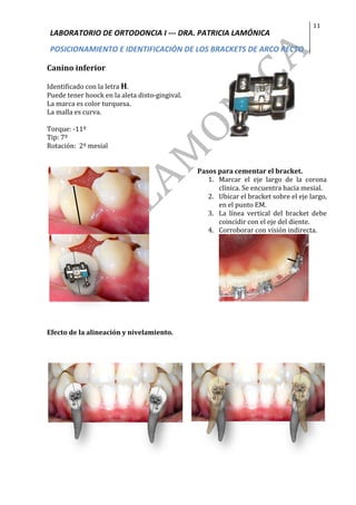 LABORATORIO	DE	ORTODONCIA	I	---	DRA.	PATRICIA	LAMÓNICA	
POSICIONAMIENTO	E	IDENTIFICACIÓN	DE	LOS	BRACKETS	DE	ARCO	RECTO	
11	
	
Canino	inferior	
	
Identificado	con	la	letra	H.		
Puede	tener	hoock	en	la	aleta	disto-gingival.	
La	marca	es	color	turquesa.	
La	malla	es	curva.	
	
Torque:	-11º	
Tip:	7º	
Rotación:		2º	mesial	
	
	
	
	
	
	
Pasos	para	cementar	el	bracket.	
1. Marcar	 el	 eje	 largo	 de	 la	 corona	
clínica.	Se	encuentra	hacia	mesial.	
2. Ubicar	el	bracket	sobre	el	eje	largo,	
en	el	punto	EM.	
3. La	 línea	 vertical	 del	 bracket	 debe	
coincidir	con	el	eje	del	diente.	
4. Corroborar	con	visión	indirecta.	
Efecto	de	la	alineación	y	nivelamiento.	
	
	
	
	
 