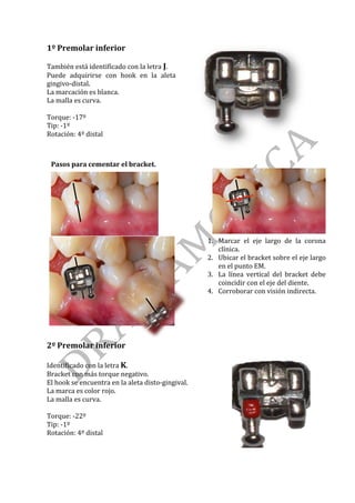 1º	Premolar	inferior	
	
También	está	identificado	con	la	letra	J.	
Puede	 adquirirse	 con	 hook	 en	 la	 aleta	
gingivo-distal.	
La	marcación	es	blanca.	
La	malla	es	curva.	
	
Torque:	-17º	
Tip:	-1º	
Rotación:	4º	distal	
	
	
	
Pasos	para	cementar	el	bracket.		
	
1. Marcar	 el	 eje	 largo	 de	 la	 corona	
clínica.	
2. Ubicar	el	bracket	sobre	el	eje	largo	
en	el	punto	EM.	
3. La	 línea	 vertical	 del	 bracket	 debe	
coincidir	con	el	eje	del	diente.	
4. Corroborar	con	visión	indirecta.
2º	Premolar	inferior	
	
	
Identificado	con	la	letra	K.	
Bracket	con	más	torque	negativo.	
El	hook	se	encuentra	en	la	aleta	disto-gingival.		
La	marca	es	color	rojo.	
La	malla	es	curva.		
	
Torque:	-22º	
Tip:	-1º	
Rotación:	4º	distal	
	
	 	
 