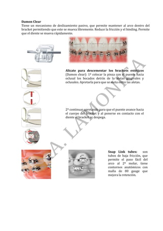 Damon	Clear	
Tiene	 un	 mecanismo	 de	 deslizamiento	 pasivo,	 que	 permite	 mantener	 al	 arco	 dentro	 del	
bracket	permitiendo	que	este	se	mueva	libremente.	Reduce	la	fricción	y	el	binding.	Permite	
que	el	diente	se	mueva	rápidamente.	
								 									 	
	
		
Alicate	 para	 descementar	 los	 brackets	 estéticos	
(Damon	clear):	1º	colocar	la	pinza	con	el	puente	hacia	
oclusal	 los	 bocados	 detrás	 de	 la	 aletas	 gingivales	 y	
oclusales.	Apretarla	para	que	se	meta	entre	las	aletas.	
	
2º	continuar	apretando	para	que	el	puente	avance	hacia	
el	 cuerpo	 del	 bracket	 y	 al	 ponerse	 en	 contacto	 con	 el	
diente	el	bracket	se	despega.		
		 	 		
	
	
Snap	 Link	 tubes:	 	 son	
tubos	 de	 baja	 fricción,	 que	
permite	 el	 paso	 fácil	 del	
arco	 al	 2º	 molar,	 tiene	
contornos	 anatómicos	 con	
malla	 de	 80	 gauge	 que	
mejora	la	retención.	
	
	
	
	
	
	
	
 