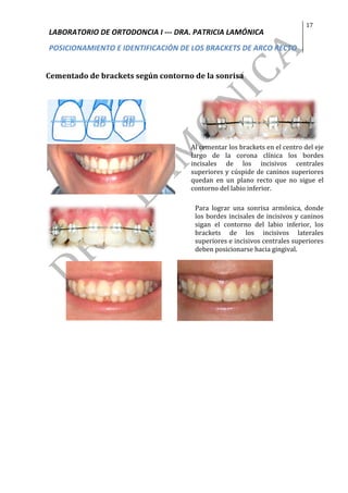 LABORATORIO	DE	ORTODONCIA	I	---	DRA.	PATRICIA	LAMÓNICA	
POSICIONAMIENTO	E	IDENTIFICACIÓN	DE	LOS	BRACKETS	DE	ARCO	RECTO	
17	
	
	
Cementado	de	brackets	según	contorno	de	la	sonrisa	
	
	
	 	
	
	
Al	cementar	los	brackets	en	el	centro	del	eje	
largo	 de	 la	 corona	 clínica	 los	 bordes	
incisales	 de	 los	 incisivos	 centrales	
superiores	y	cúspide	de	caninos	superiores	
quedan	 en	 un	 plano	 recto	 que	 no	 sigue	 el	
contorno	del	labio	inferior.	
		
	
Para	 lograr	 una	 sonrisa	 armónica,	 donde	
los	bordes	incisales	de	incisivos	y	caninos	
sigan	 el	 contorno	 del	 labio	 inferior,	 los	
brackets	 de	 los	 incisivos	 laterales	
superiores	e	incisivos	centrales	superiores	
deben	posicionarse	hacia	gingival.	
													 										 				
	
 