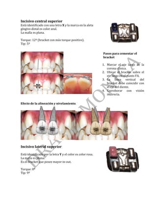 Incisivo	central	superior	
Está	identificado	con	una	letra	X	y	la	marca	en	la	aleta	
gíngivo	distal	es	color	azul.	
La	malla	es	plana.	
	
Torque:	12º	(bracket	con	más	torque	positivo).	
Tip:	5º	 	
	
	
		
		
	
	
Pasos	para	cementar	el	
bracket	
	
1. Marcar	 el	 eje	 largo	 de	 la	
corona	clínica.	
2. Ubicar	 el	 bracket	 sobre	 el	
eje	largo	en	el	punto	FA.	
3. La	 línea	 vertical	 del	
bracket	debe	coincidir	con	
el	eje	del	diente.	
4. Corroborar	 con	 visión	
indirecta.	
	
Efecto	de	la	alineación	y	nivelamiento.	
	
Incisivo	lateral	superior	
	
Está	identificado	por	la	letra	Y	y	el	color	es	color	rosa.	
La	malla	es	plana.	
Es	el	bracket	que	posee	mayor	in-out.	
	
Torque:	8º	
Tip:	9º	 	
	
	
	
 
