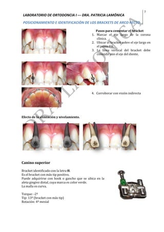 LABORATORIO	DE	ORTODONCIA	I	---	DRA.	PATRICIA	LAMÓNICA	
POSICIONAMIENTO	E	IDENTIFICACIÓN	DE	LOS	BRACKETS	DE	ARCO	RECTO	
7	
	
		
	
	
Pasos	para	cementar	el	bracket	
1. Marcar	 el	 eje	 largo	 de	 la	 corona	
clínica.	
2. Ubicar	el	bracket	sobre	el	eje	largo	en	
el	punto	FA.	
3. La	 línea	 vertical	 del	 bracket	 debe	
coincidir	con	el	eje	del	diente.	
	
	
	
	
	4.			Corroborar	con	visión	indirecta	
	
	
	
	
Efecto	de	la	alineación	y	nivelamiento.	
	 	
	
Canino	superior	
	
Bracket	identificado	con	la	letra	H.		
Es	el	bracket	con	más	tip	positivo.			
Puede	 adquirirse	 con	 hook	 o	 gancho	 que	 se	 ubica	 en	 la	
aleta	gingivo	distal,	cuya	marca	es	color	verde.		
La	malla	es	curva.		
	
Torque:	-2º	
Tip:	13º	(bracket	con	más	tip)		
Rotación:	4º	mesial	
	
	
				
 