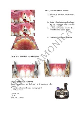 Pasos	para	cementar	el	bracket	
	
1. Marcar	 el	 eje	 largo	 de	 la	 corona	
clínica.	
	
	
2. Ubicar	el	bracket	sobre	el	eje	largo,	
que	 se	 encuentra	 más	 a	 mesial,	
sobre	el	punto	FA.	
3. La	 línea	 vertical	 del	 bracket	 debe	
coincidir	con	el	eje	del	diente.		
	
	
	
4. Corroborar	con	visión	indirecta.	
	
	
	
	
	
	
	
Efecto	de	la	alineación	y	nivelamiento.	
	 	
	
1º	y	2º	premolar	superior	
	
Bracket	 identificado	 por	 la	 letra	 J	 y	 la	 marca	 es	 color	
violeta.	
Pueden	tener	hook	en	la	aleta	mesio-gingival.	
La	malla	es	curva.	
	
Torque:	-7º	
Tip:	0º	
Rotación:	2º	distal	
	
	
	
	
 