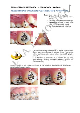 LABORATORIO	DE	ORTODONCIA	I	---	DRA.	PATRICIA	LAMÓNICA	
POSICIONAMIENTO	E	IDENTIFICACIÓN	DE	LOS	BRACKETS	DE	ARCO	RECTO	
9	
	
	
Pasos	para	cementar	el	bracket.	
1. Marcar	 el	 eje	 largo	 de	 la	 corona	
clínica.	
2. Ubicar	el	bracket	sobre	el	eje	largo.	
3. La	 línea	 vertical	 del	 bracket	 debe	
coincidir	con	el	eje	del	diente.	
4. Corroborar	con	visión	indirecta.	
	
	 	
	
	
	
	
Hay	que	tener	en	cuenta	que	el	2º	premolar	superior	es	el	
diente	 que,	 generalmente,	 erupciona	 último	 y	 su	 corona	
clínica	 suele	 presentar	 menor	 altura	 en	 sentido	 gíngivo	
oclusal.		
Si	 el	 bracket	 se	 posiciona	 en	 el	 centro	 del	 eje	 largo	
quedará	muy	a	incisal	y	el	diente	se	intruirá	y	quedará	con	
torque	positivo.		
	
Para	evitar	esto,	el	bracket	debe	cementarse	más	a	gingival	tomando	como	referencia	el	1º	
premolar	(0,5mm	a	oclusal)	.	
				 	
	
	 	
 