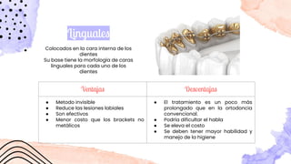 Colocados en la cara interna de los
dientes
Su base tiene la morfología de caras
linguales para cada uno de los
dientes
Linguales
Ventajas Desventajas
● Metodo invisible
● Reduce las lesiones labiales
● Son efectivos
● Menor costo que los brackets no
metálicos
● El tratamiento es un poco más
prolongado que en la ortodoncia
convencional.
● Podría dificultar el habla
● Se eleva el costo
● Se deben tener mayor habilidad y
manejo de la higiene
 