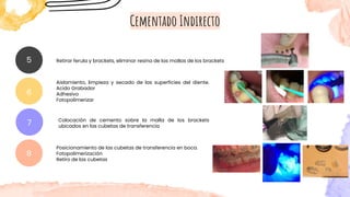Cementado Indirecto
Retirar ferula y brackets, eliminar resina de las mallas de los brackets
5
6
Aislamiento, limpieza y secado de las superficies del diente.
Acido Grabador
Adhesivo
Fotopolimerizar
7 Colocación de cemento sobre la malla de los brackets
ubicados en las cubetas de transferencia
8
Posicionamiento de las cubetas de transferencia en boca.
Fotopolimerización
Retiro de las cubetas
 