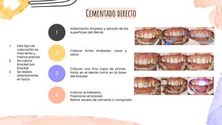 Cementado directo
1. Este tipo de
colocación es
más lenta y
menos precisa
2. Se coloca
bracket por
bracket
3. Se realiza
directamente
en boca
Aislamiento, limpieza y secado de las
superficies del diente.
1
2
Colocar Acido Grabador. Lavar y
secar
3
Colocar una fina capa de primer,
tanto en el diente como en la base
del bracket
4
Colocar el Adhesivo.
Posicionar el bracket.
Retirar exceso de cemento o composite .
 