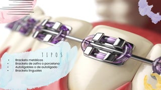 T I P O S
• Brackets metálicos
• Brackets de zafiro o porcelana
• Autoligables o de autoligado
• Brackets linguales
 