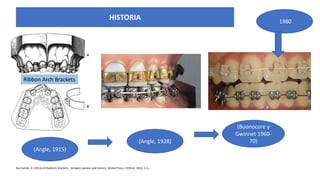 (Angle, 1915)
(Buonocore y
Gwinnet 1960-
70)
1980
Normando, D. (2013).Orthodontic brackets - between passion and Science. Dental Press J. Orthod, 18(3), 1-2.
HISTORIA
(Angle, 1928)
Ribbon Arch Brackets
 