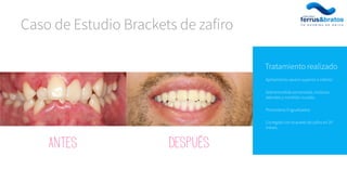 Apiñamiento severo superior e inferior.
Sobremordida aumentada, incisivos
laterales y mordida cruzada.
Premolares lingualizados.
Corregido con brackets de zafiro en 20
meses.
Tratamiento realizado
Caso de Estudio Brackets de zafiro
Antes Después