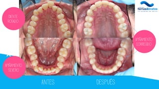 Antes Después
Diente
Rotado
Apiñamiento
severo
Apiñamiento
corregido