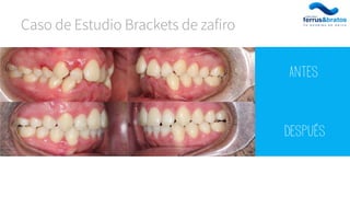 Caso de Estudio Brackets de zafiro
Antes
Después