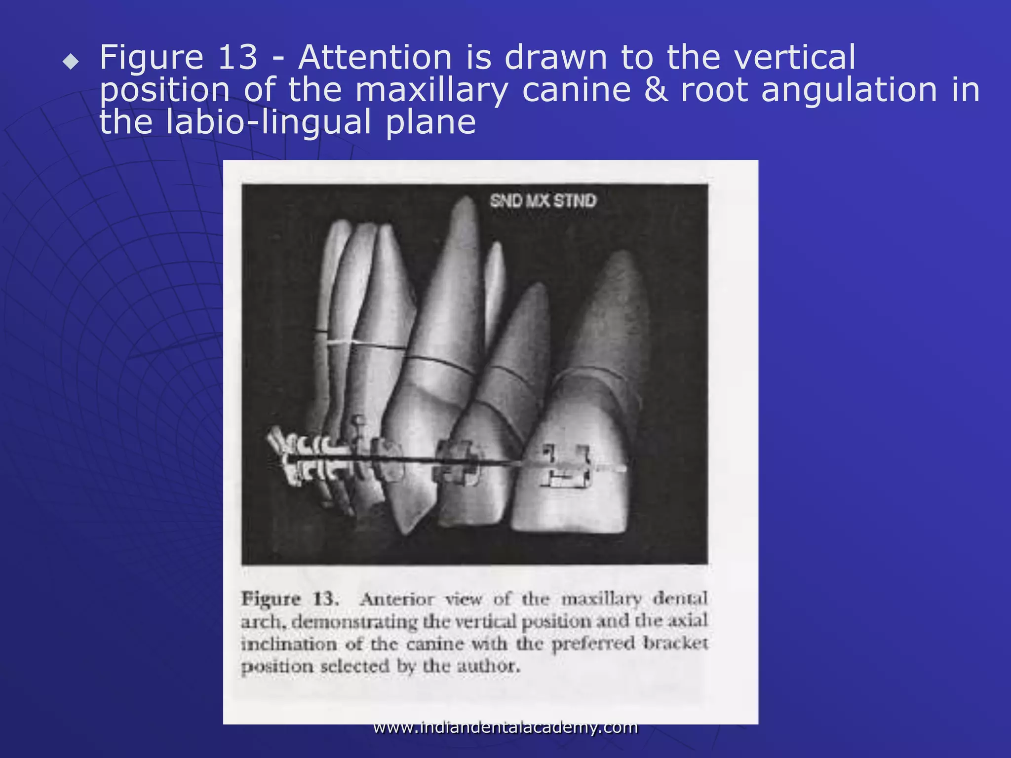  Figure 13 - Attention is drawn to the vertical
position of the maxillary canine & root angulation in
the labio-lingual plane
www.indiandentalacademy.com
 