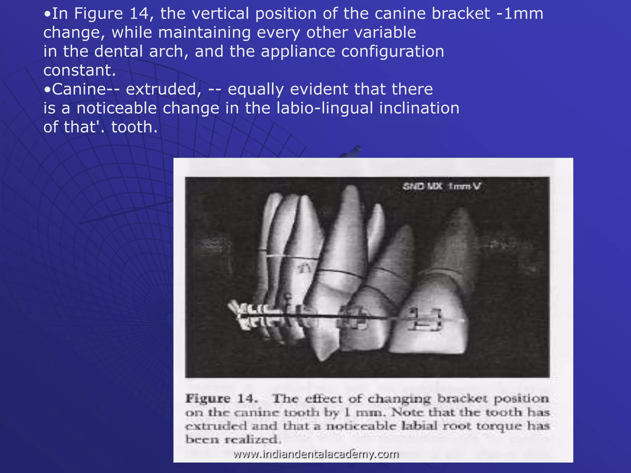 •In Figure 14, the vertical position of the canine bracket -1mm
change, while maintaining every other variable
in the dental arch, and the appliance configuration
constant.
•Canine-- extruded, -- equally evident that there
is a noticeable change in the labio-lingual inclination
of that'. tooth.
www.indiandentalacademy.com
 