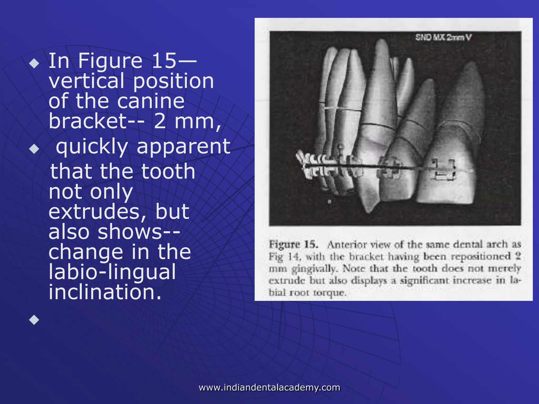  In Figure 15—
vertical position
of the canine
bracket-- 2 mm,
 quickly apparent
that the tooth
not only
extrudes, but
also shows--
change in the
labio-lingual
inclination.

www.indiandentalacademy.com
 