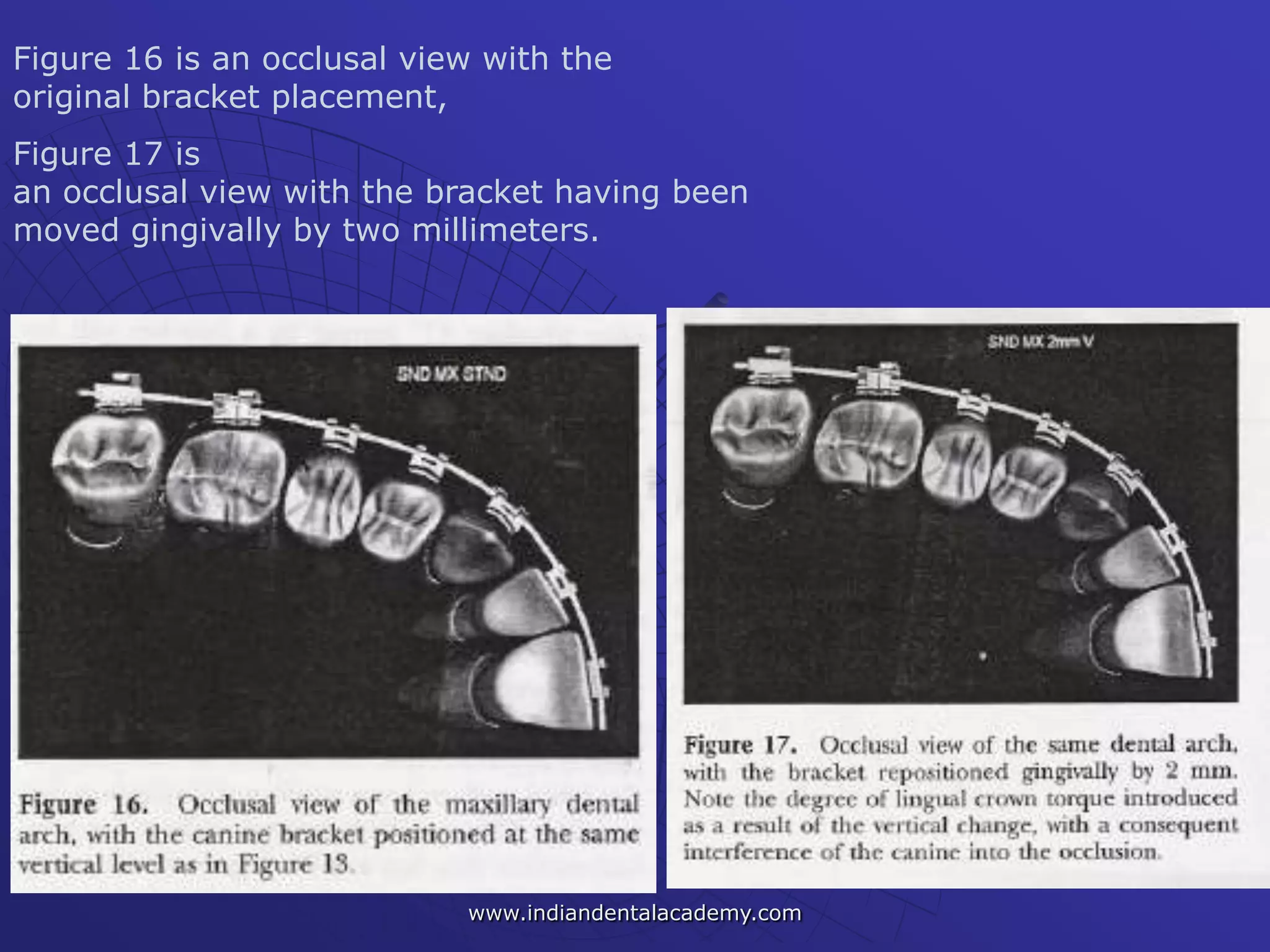 Figure 16 is an occlusal view with the
original bracket placement,
Figure 17 is
an occlusal view with the bracket having been
moved gingivally by two millimeters.
www.indiandentalacademy.com
 