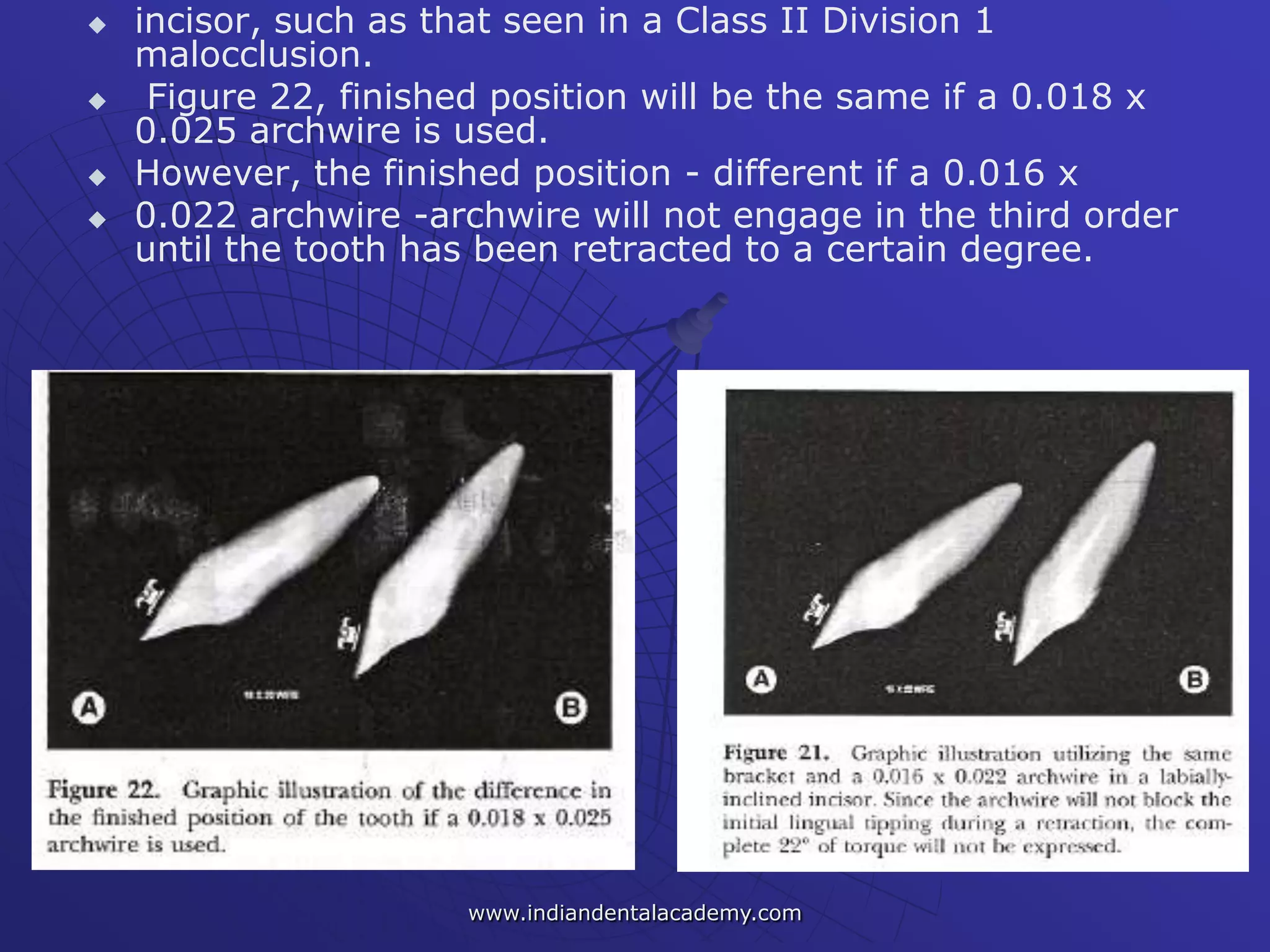  incisor, such as that seen in a Class II Division 1
malocclusion.
 Figure 22, finished position will be the same if a 0.018 x
0.025 archwire is used.
 However, the finished position - different if a 0.016 x
 0.022 archwire -archwire will not engage in the third order
until the tooth has been retracted to a certain degree.
www.indiandentalacademy.com
 