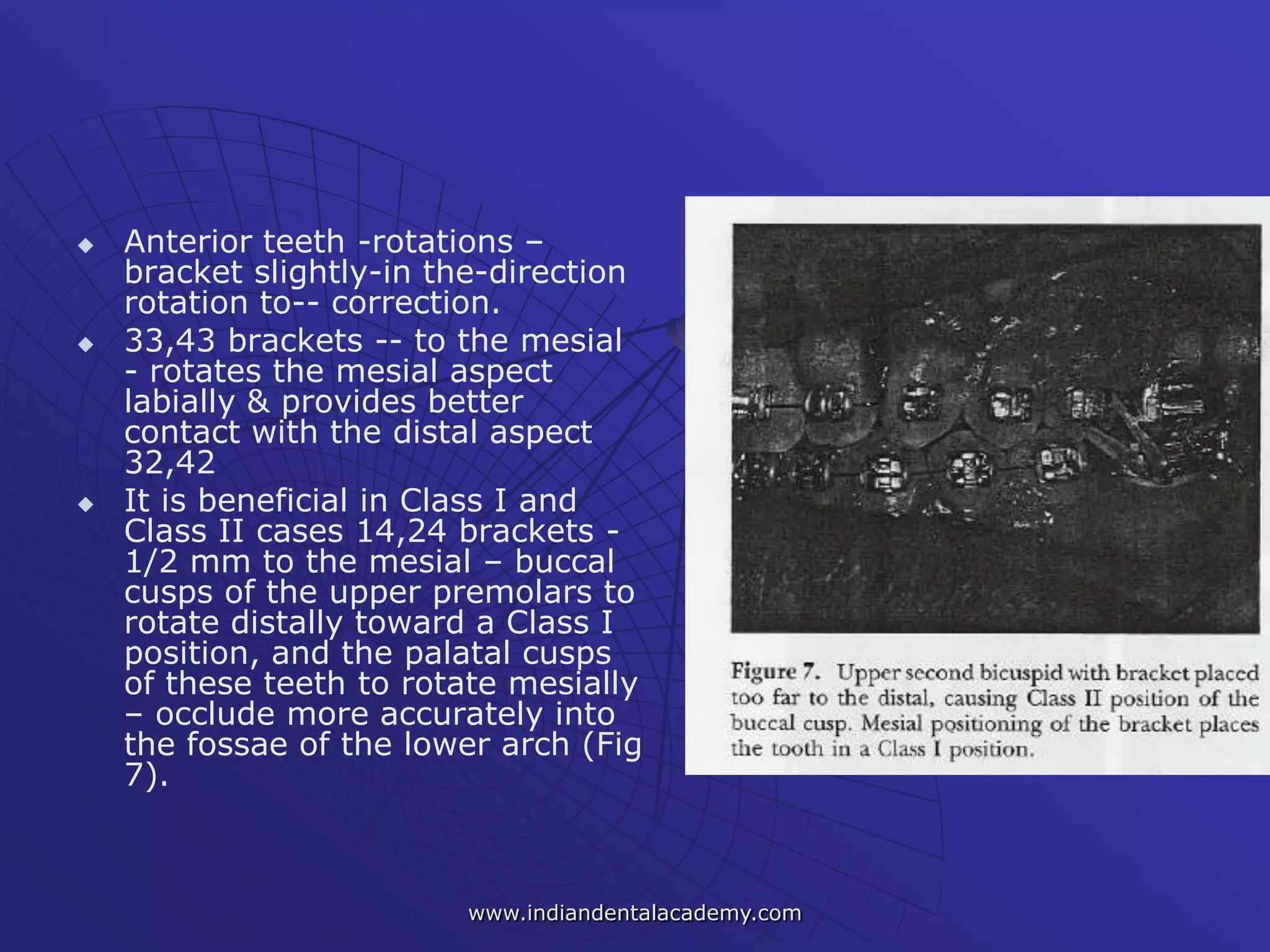  Anterior teeth -rotations –
bracket slightly-in the-direction
rotation to-- correction.
 33,43 brackets -- to the mesial
- rotates the mesial aspect
labially & provides better
contact with the distal aspect
32,42
 It is beneficial in Class I and
Class II cases 14,24 brackets -
1/2 mm to the mesial – buccal
cusps of the upper premolars to
rotate distally toward a Class I
position, and the palatal cusps
of these teeth to rotate mesially
– occlude more accurately into
the fossae of the lower arch (Fig
7).
www.indiandentalacademy.com
 