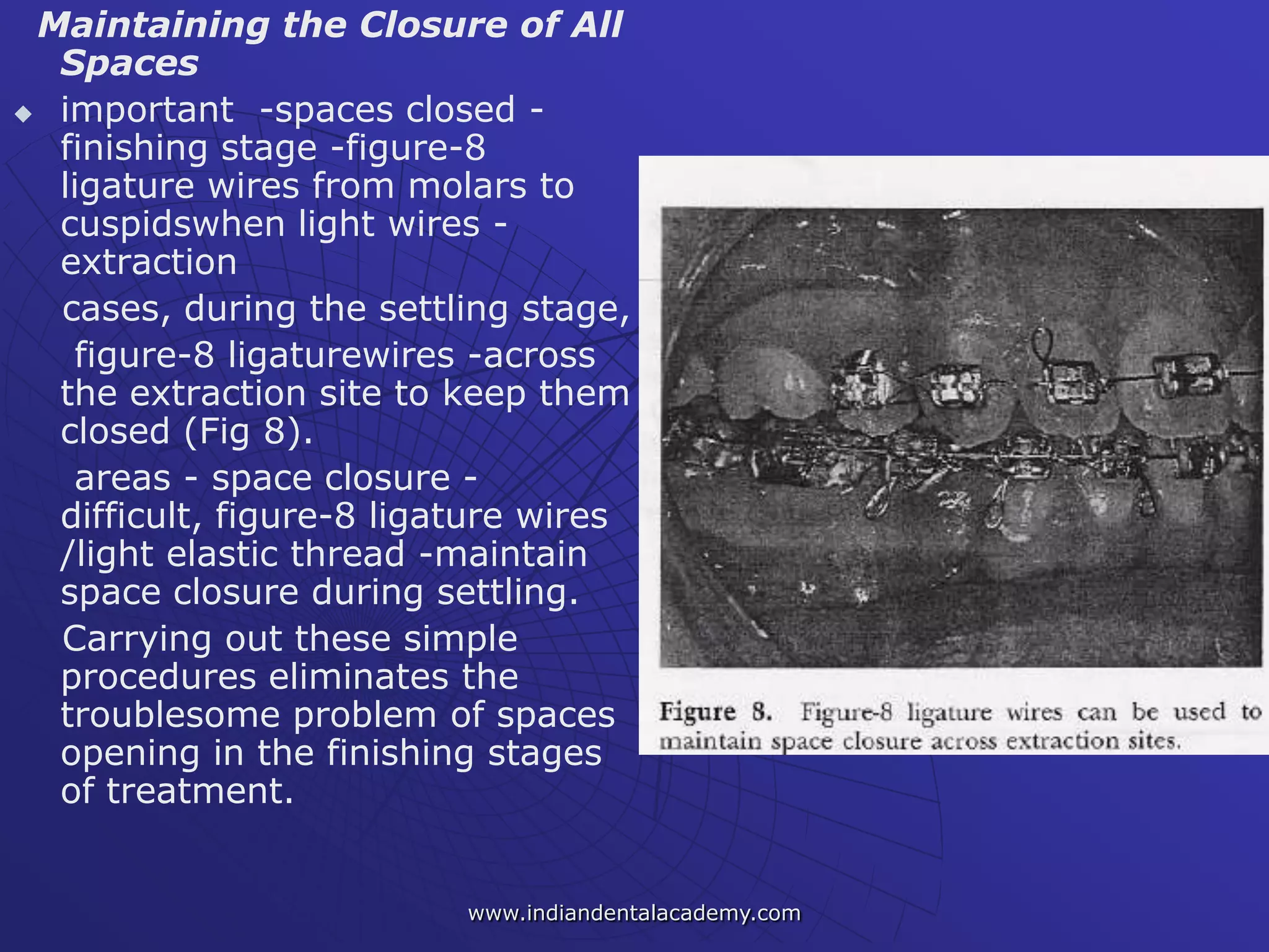 Maintaining the Closure of All
Spaces
 important -spaces closed -
finishing stage -figure-8
ligature wires from molars to
cuspidswhen light wires -
extraction
cases, during the settling stage,
figure-8 ligaturewires -across
the extraction site to keep them
closed (Fig 8).
areas - space closure -
difficult, figure-8 ligature wires
/light elastic thread -maintain
space closure during settling.
Carrying out these simple
procedures eliminates the
troublesome problem of spaces
opening in the finishing stages
of treatment.
www.indiandentalacademy.com
 