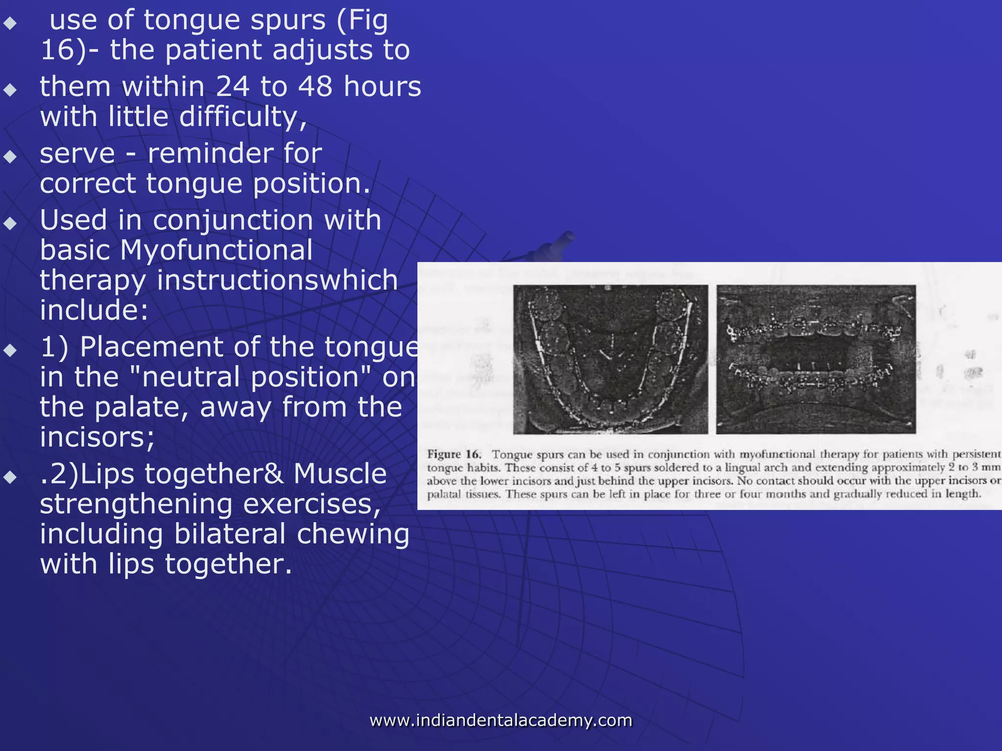  use of tongue spurs (Fig
16)- the patient adjusts to
 them within 24 to 48 hours
with little difficulty,
 serve - reminder for
correct tongue position.
 Used in conjunction with
basic Myofunctional
therapy instructionswhich
include:
 1) Placement of the tongue
in the "neutral position" on
the palate, away from the
incisors;
 .2)Lips together& Muscle
strengthening exercises,
including bilateral chewing
with lips together.
www.indiandentalacademy.com
 
