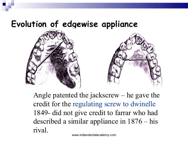 brackets in orthodontics certified fixed orthodontic courses by indi edgewise appliance